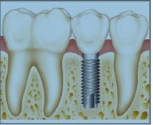 Tandimplantat - ett sätt att ersätta förlorade tänder