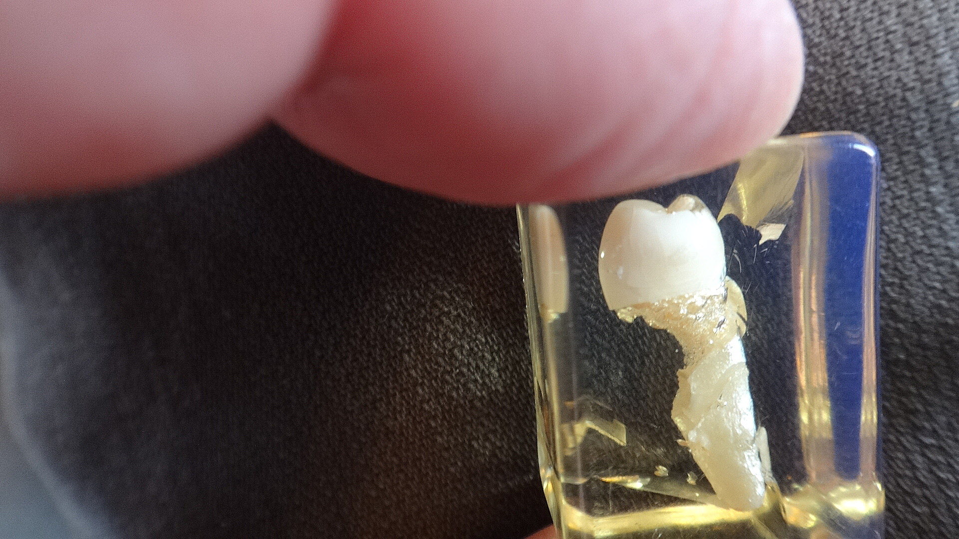 Li visade från sin tandläkartid ett exempel på en tand som angripits just i kanten av kronan.